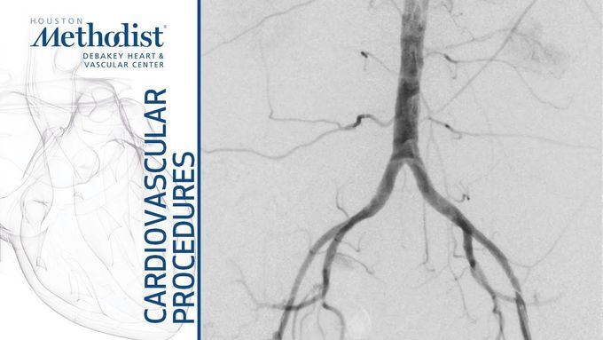 Angioplasty and Stenting of the External Iliac Artery