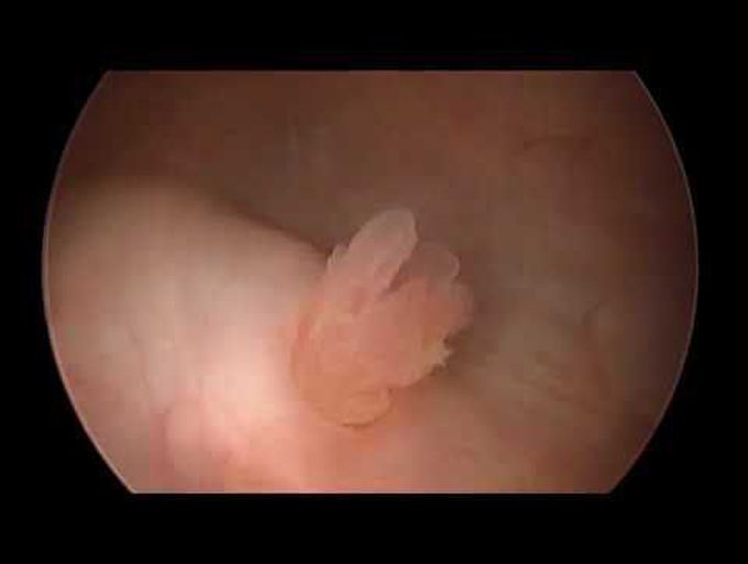 Urothelial Carcinoma