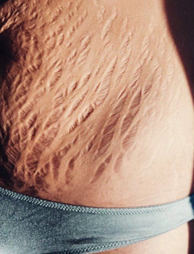Stretch marks are particularly... 