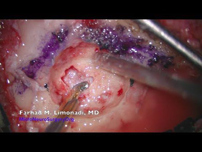 Trigeminal Neuralgia Surgery : MVD for treatment of severe facial pain