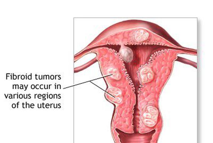 Uterine fibroids