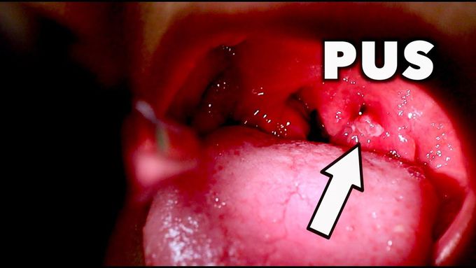 mild tonsil stones