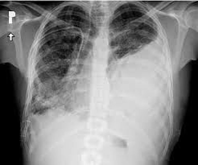 Causes of massive hemothorax