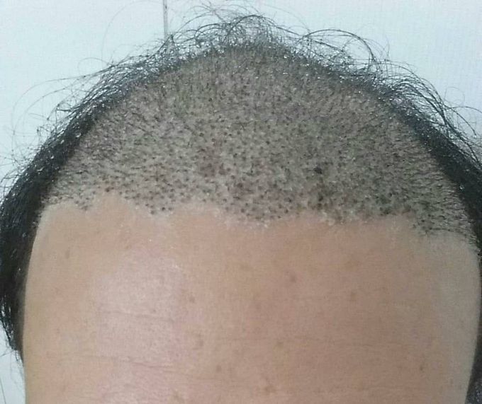 Without shaving hair transplant