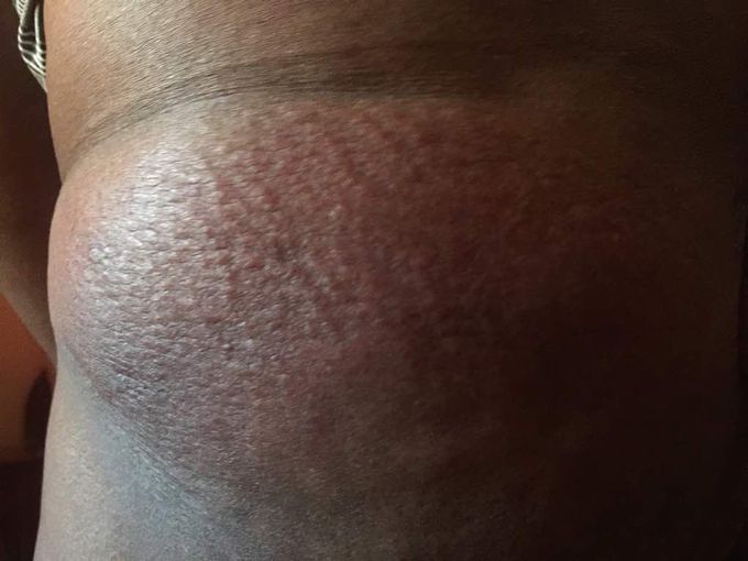 Diagnosis ?
