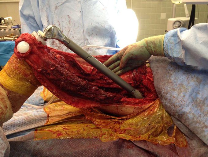 Total femur replacement surgery due to a chondrosarcoma - a metastatic bone cancer!