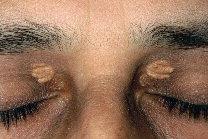 Xanthelasma