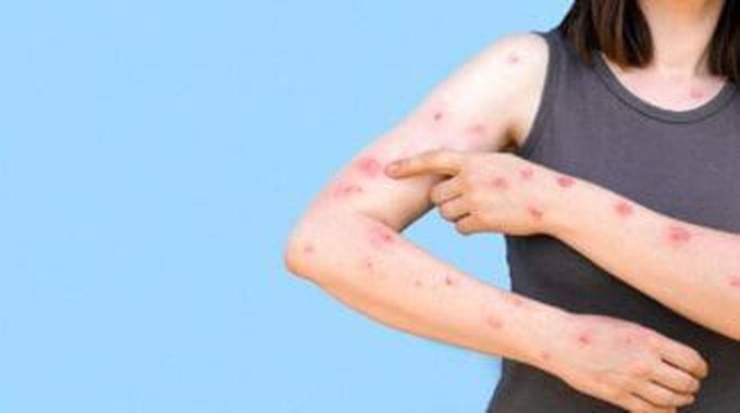 Symptoms of monkey pox