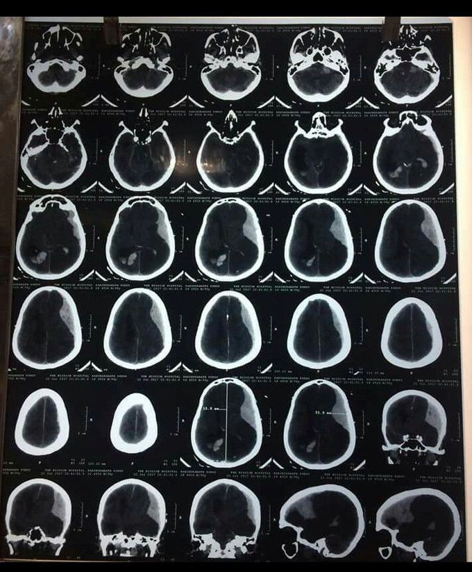 A patient presents to you in ER, after a road traffic accident. You get a brain CT scan done. It shows these findings. What is your diagnosis?