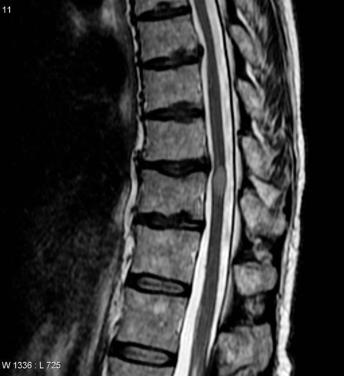 Diagnosis of Transverse myelitis