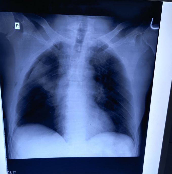 R sided pneumothorax