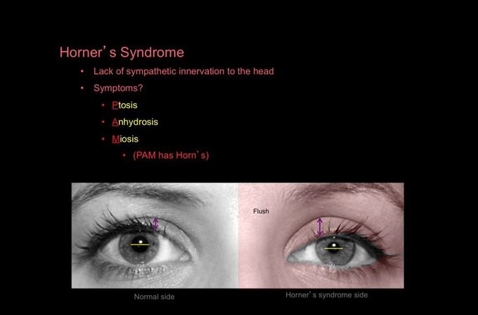Horner’s Syndrome