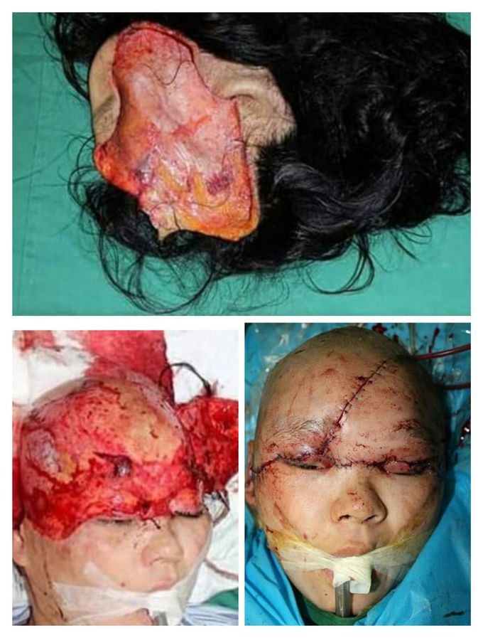 Scalp ripped off completely!!