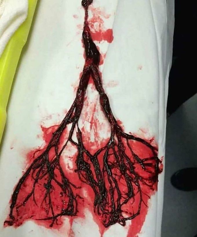 Emergency Medicine- Case of Blood Clot