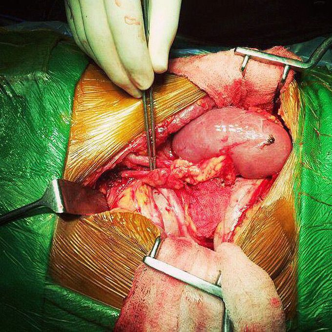 Kidney transplant surgery