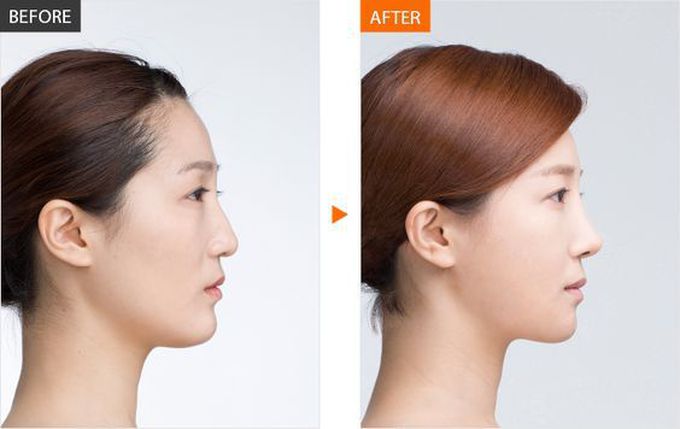 Corrective Rhinoplasty