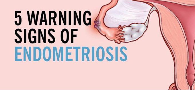 Warning signs of Endometriosis