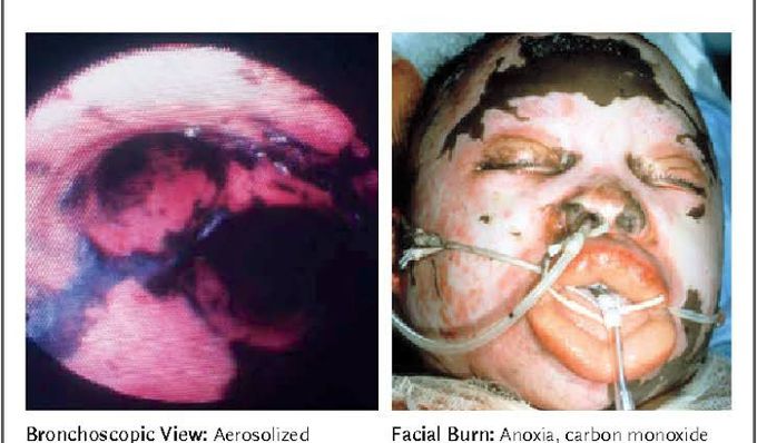 Inhalation burn