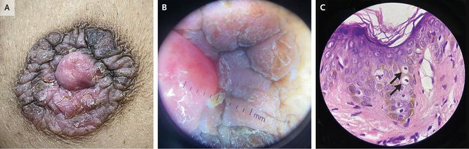 Paget's Disease of the Breast - MEDizzy