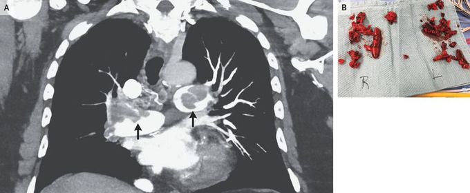 Thrombus in Transit