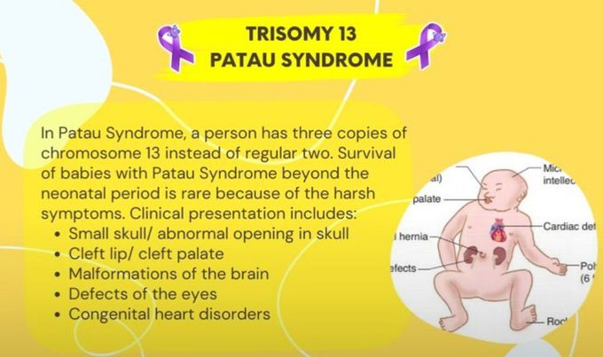 Trisomy 13