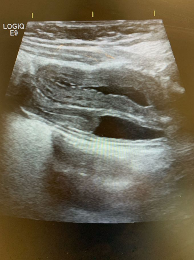 Can you tell what is the pathology here?