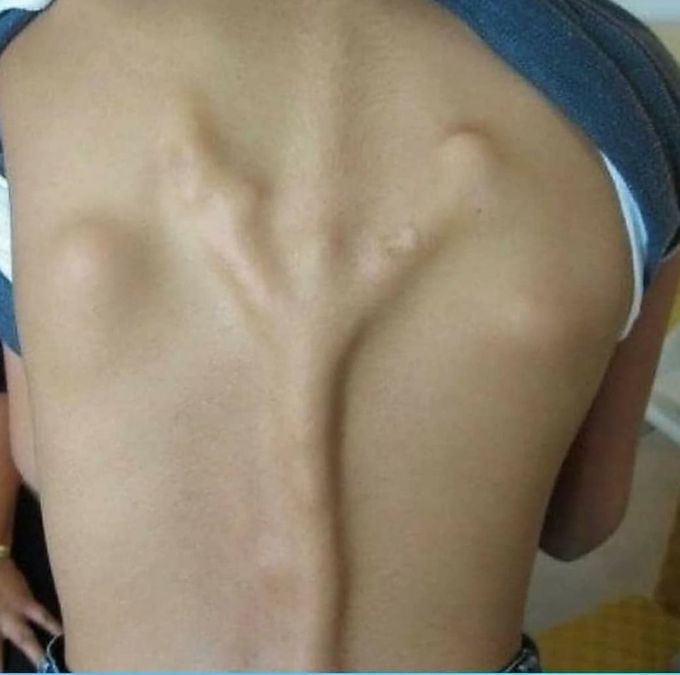 Fibrodysplasia Ossificans Progressive