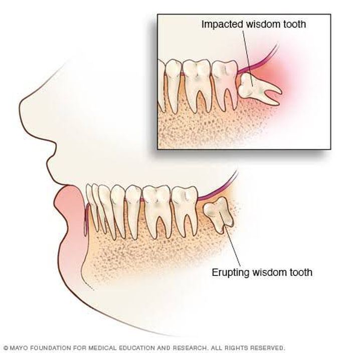 Impacted wisdom tooth