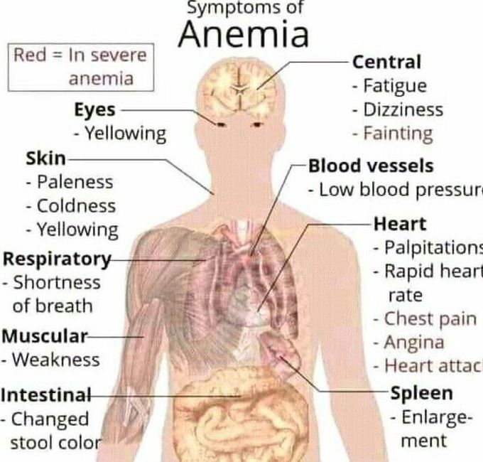 Anemia
