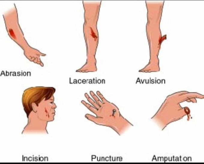 Types of wound.