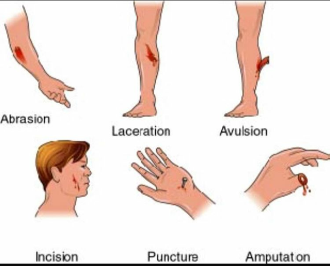 Types of wound. MEDizzy