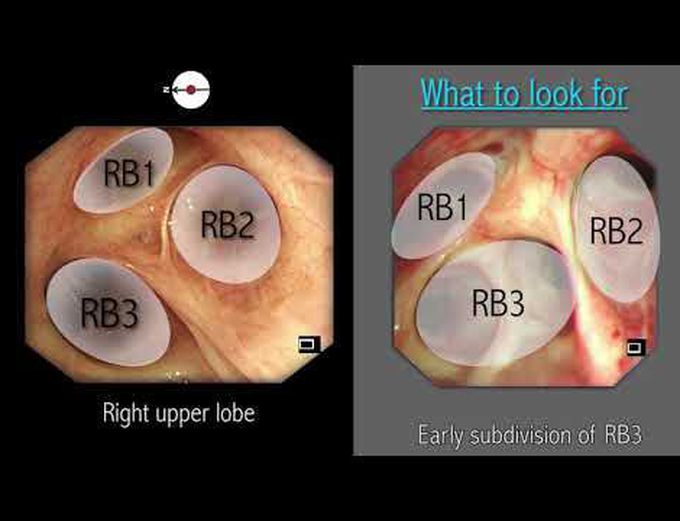 Mastering Bronchoscopy for Thoracic Surgery: Chapter 2