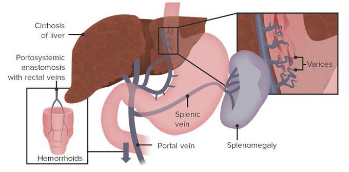 causes of portal hypertension