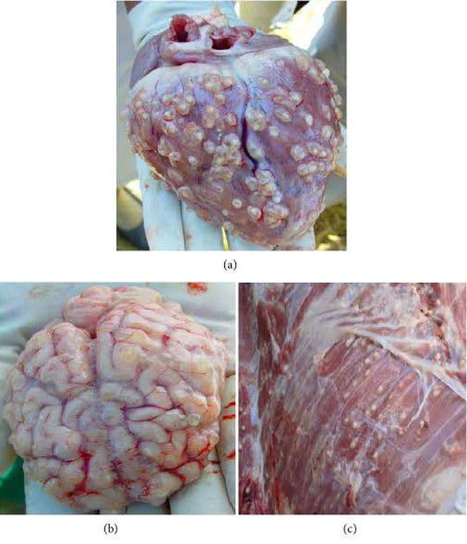 CYSTICERCOSIS