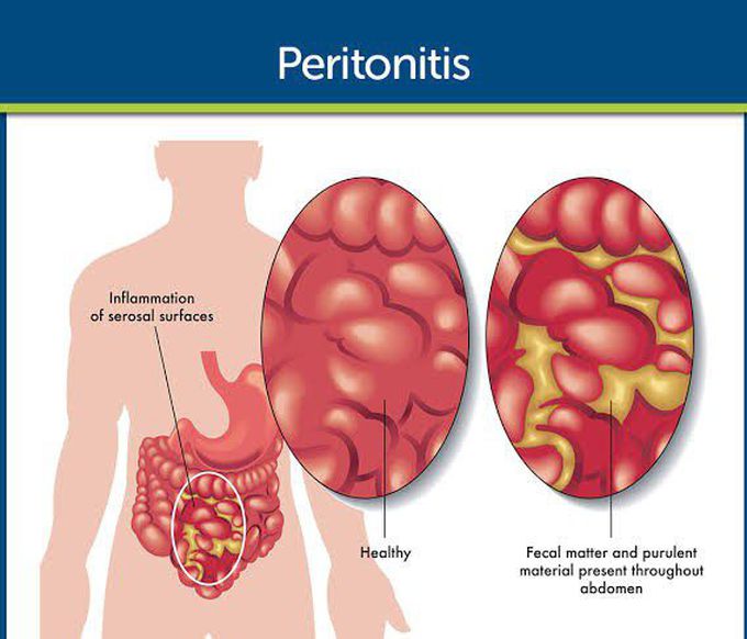 Causes of peritonitis