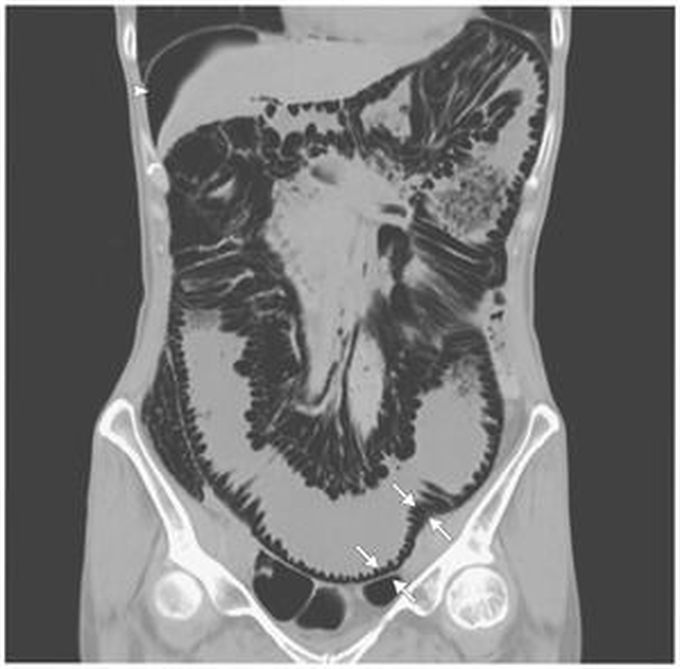 Pneumatosis Cystoides Intestinalis