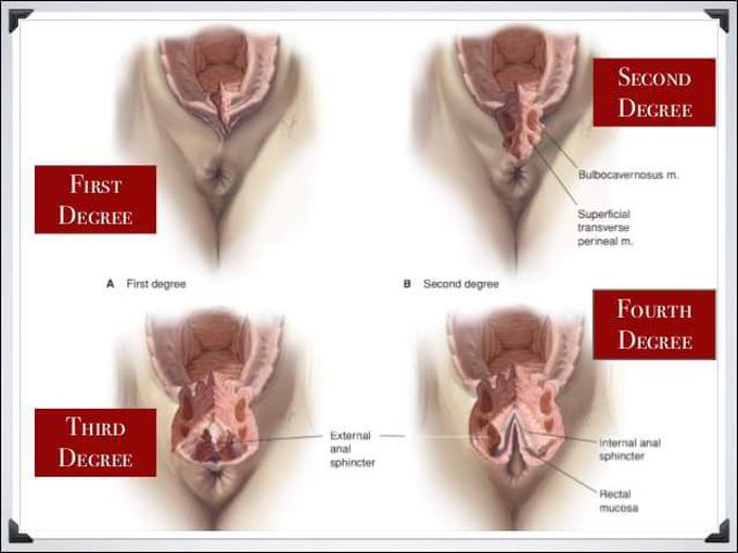Anorectal Diseases