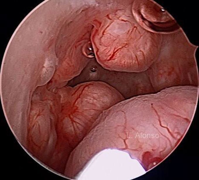 Hysteroscopy
