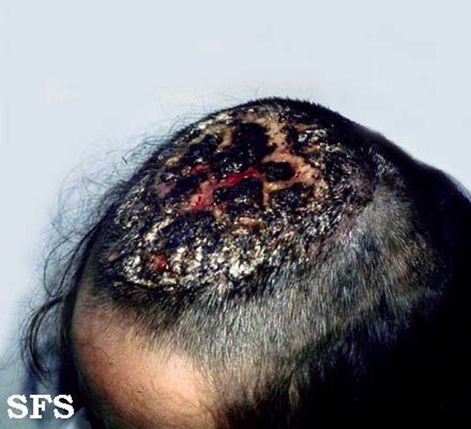 Kerion: A Fungal Infection of the Scalp