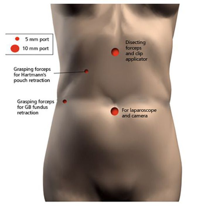 Laparoscopic Ports of Cholecystectomy