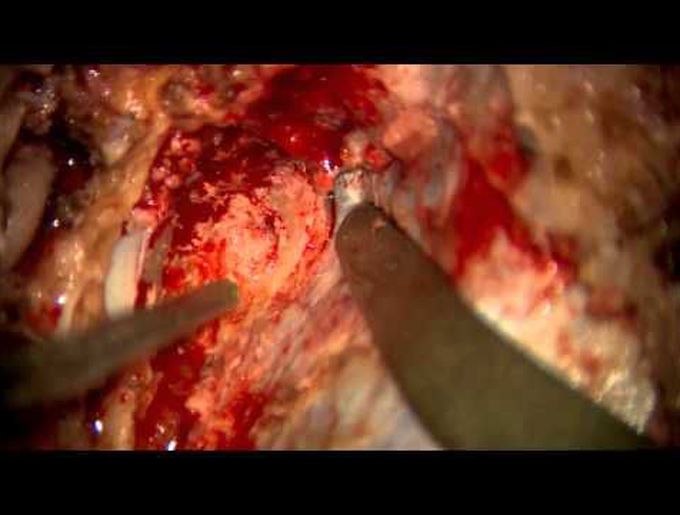 Trapping and V3–radial artery graft–V4 bypass for ruptured dissecting aneur. of the VA