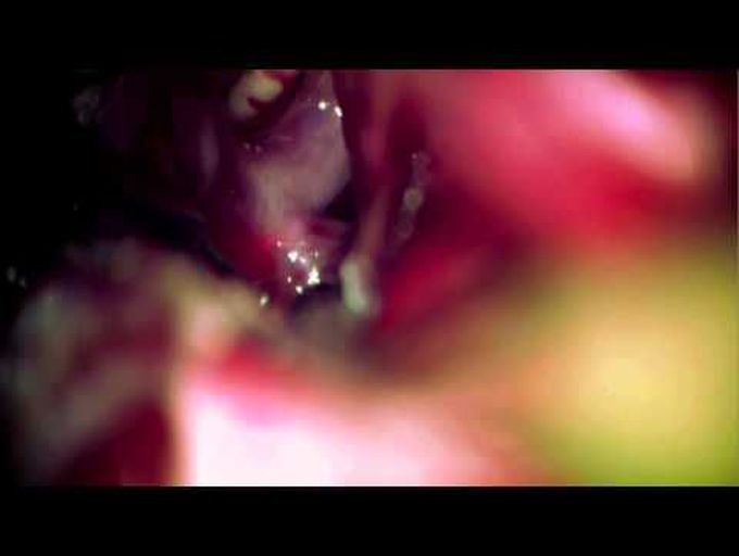 Clip ligation of contralateral P1 aneurysm