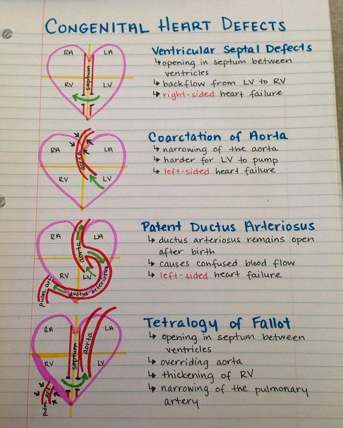 Congenital Heart Defects
