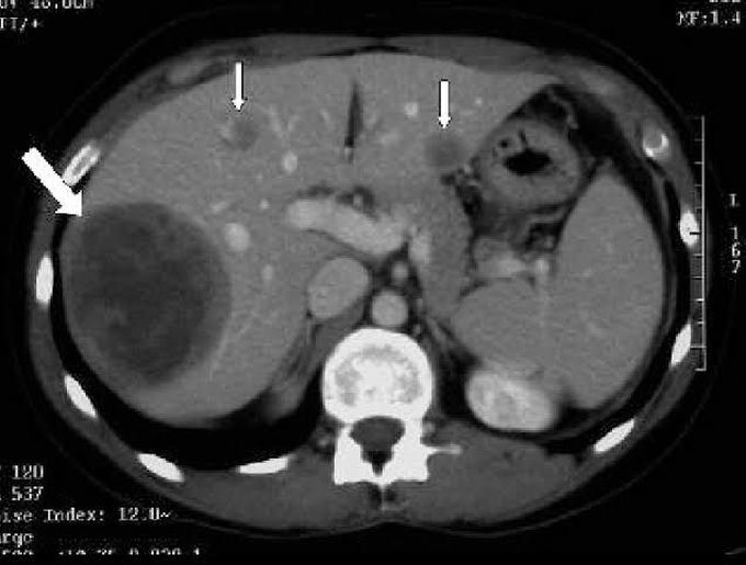 Hypodense lesions