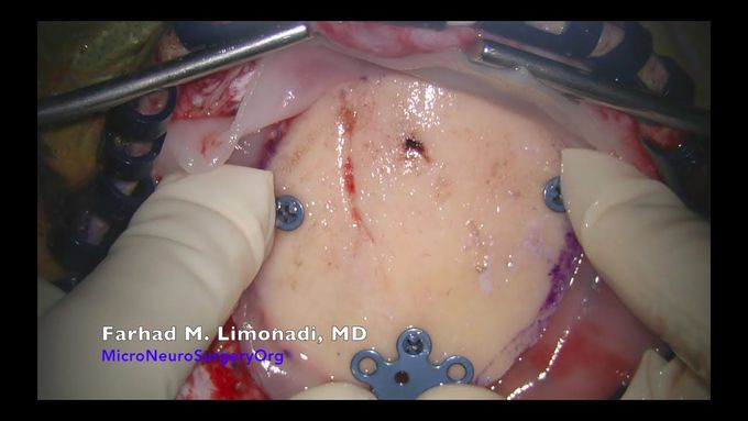 Brain surgery: Surgical resection of large Glioblastoma Multiforme (GBM)