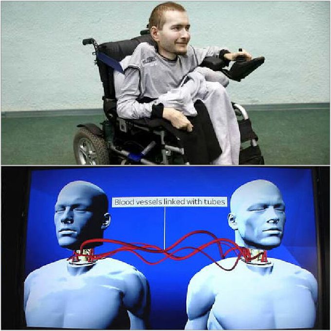 Head transplant