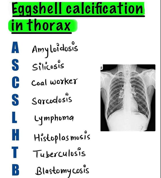Eggshell Calcification in Thorax