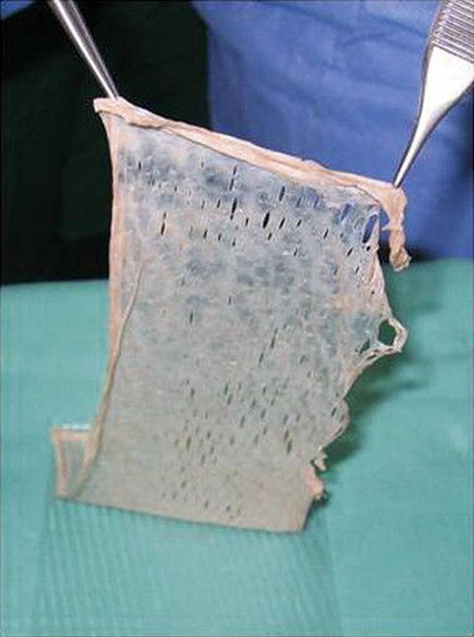 skin graft