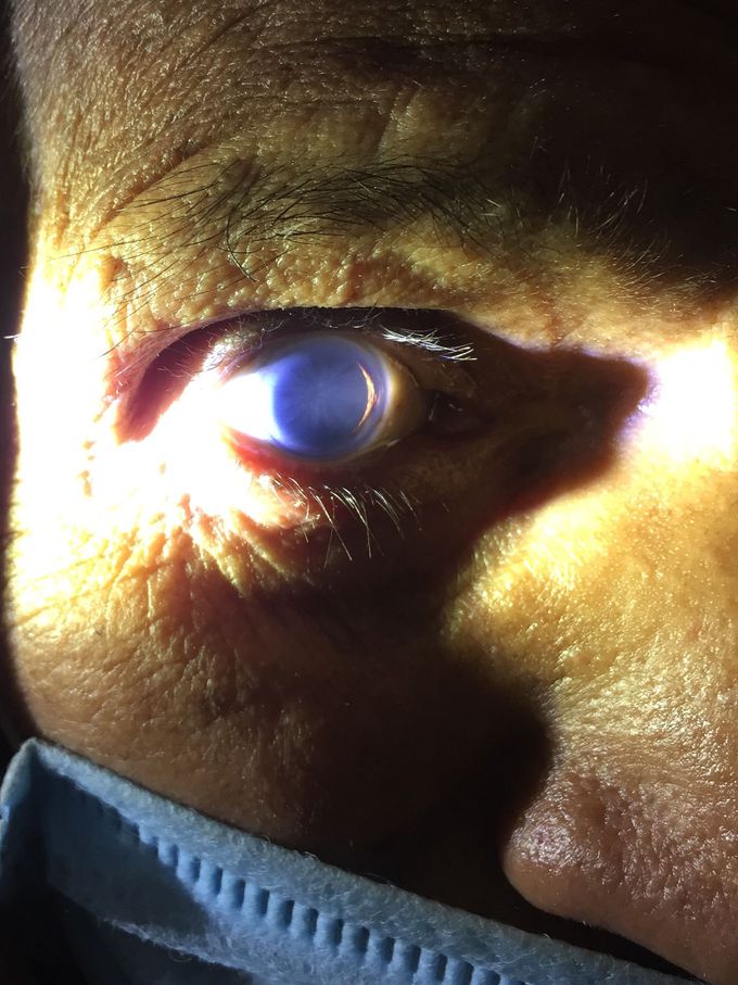 Posterior cortical cataract