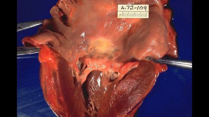 Rheumatic valvular heart disease